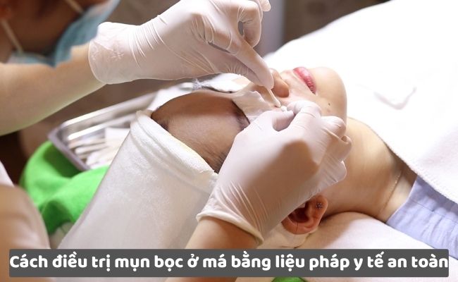Lấy nhân mụn bọc ở má tại các cơ sở uy tín

