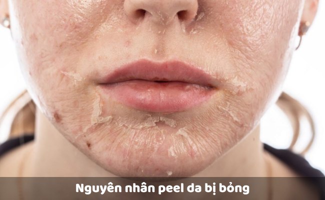 Nguyên nhân peel da bị bỏng
