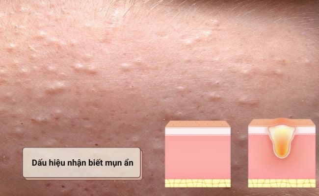 Mụn ẩn là gì? Dấu hiệu nhận biết mụn ẩn