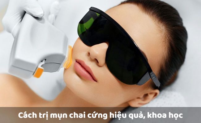 Trị mụn chai bằng công nghệ cao
