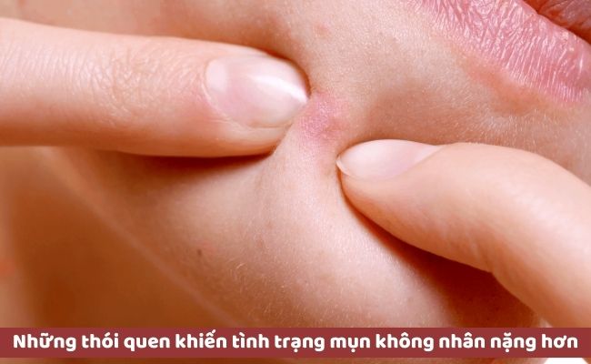 Những thói quen khiến tình trạng mụn không nhân viêm đỏ càng nặng hơn