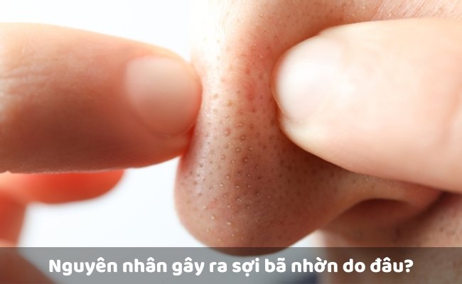 Nguyên nhân gây ra sợi bã nhờn do đâu