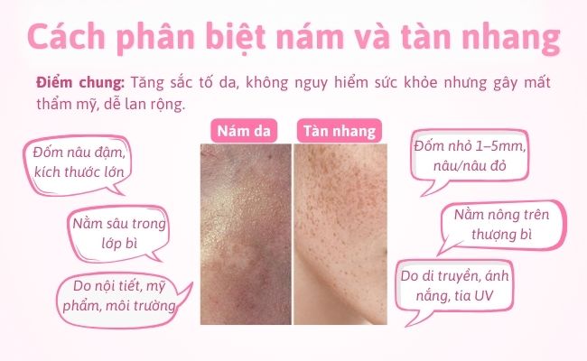 Cách phân biệt nám và tàn nhang