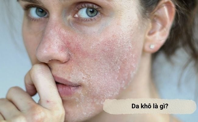 Hình ảnh da khô mất nước ở lớp biểu bì, dễ bong tróc và khô ráp