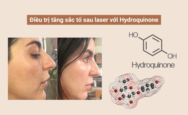 Thoa sản phẩm chứa Hydroquinone là cách trị tăng sắc tố sau laser hiệu quả