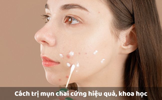 Sử dụng thuốc trị mụn chai cứng dạng bôi
 
  