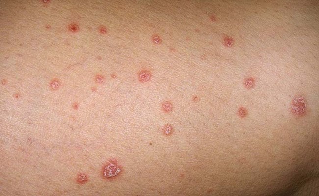 Dấu hiệu của bệnh vảy nến


