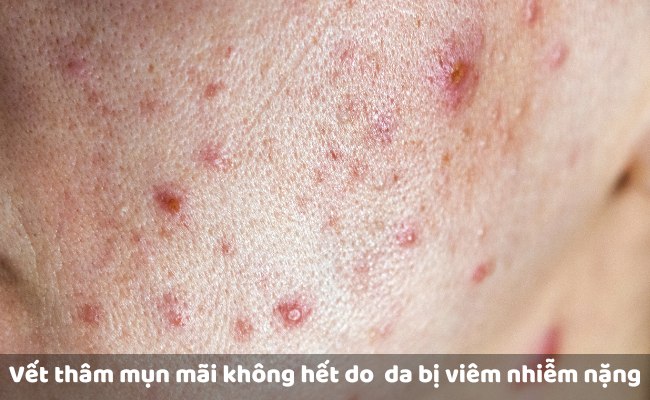 Da bị viêm nhiễm nặng khiến vết thâm mụn mãi không hết

