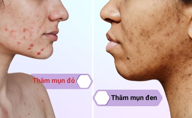 Thâm mụn là gì?