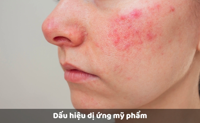 Dấu hiệu dị ứng mỹ phẩm