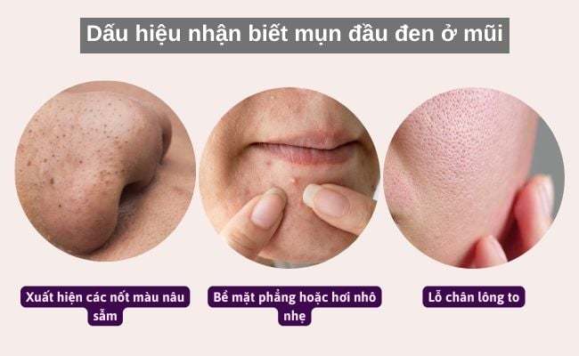 Dấu hiệu nhận biết mụn đầu đen ở mũi
