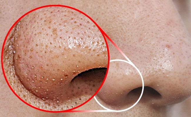 Cách trị mụn đầu đen tại nhà, Nguyên nhân & Cách chăm sóc 
