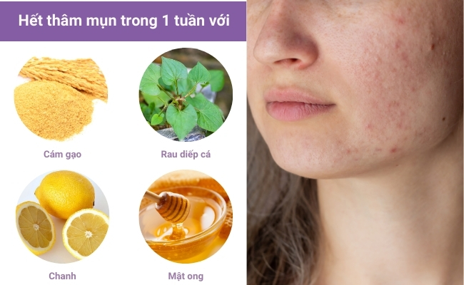 Tạm biệt thâm mụn với nguyên liệu tự nhiên ngay tại nhà