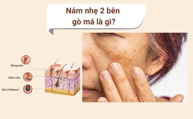 Nám nhẹ 2 bên gò má là gì
