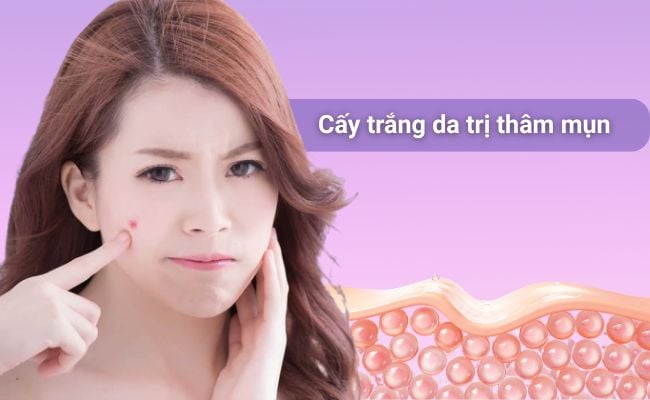 Cấy trắng da trị thâm mụn
