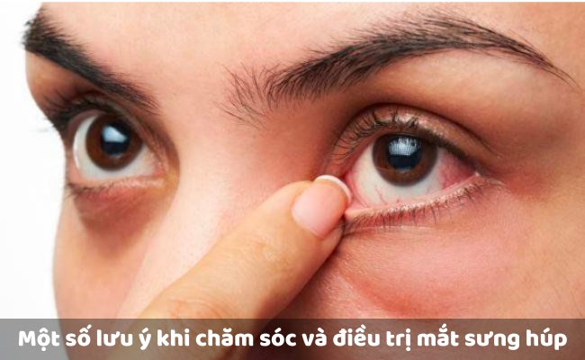 Một số lưu ý khi chăm sóc và điều trị mắt sưng húp

