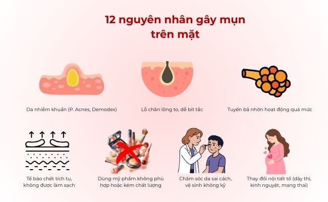 12 nguyên nhân gây mụn trên mặt phổ biến
