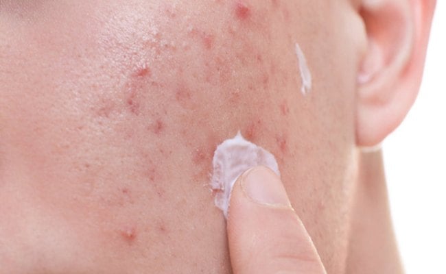 Cách trị mụn trên mặt với Azelaic Acid