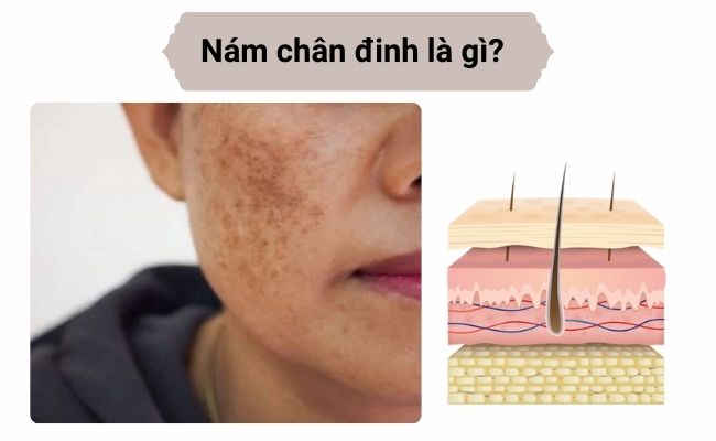 Nám chân đinh là gì