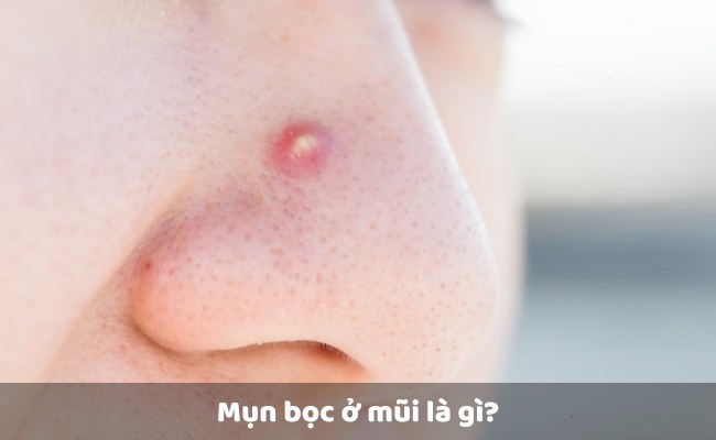 Mụn bọc ở mũi là gì?