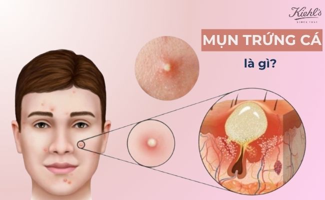 Mụn trứng cá là gì?
