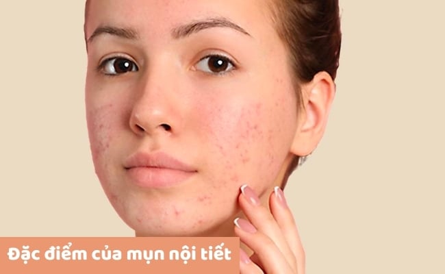 Treatment trị mụn là gì?