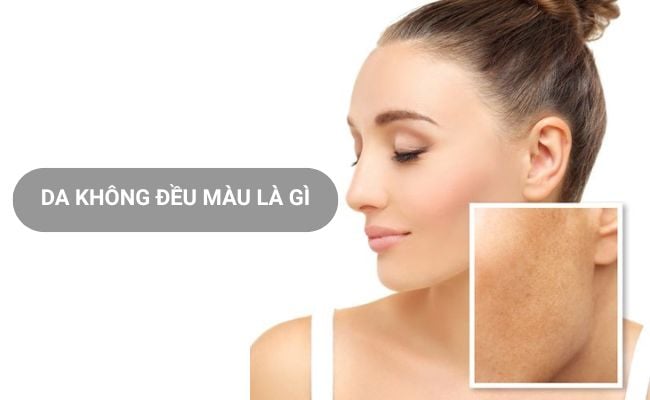 Da không đều màu là gì