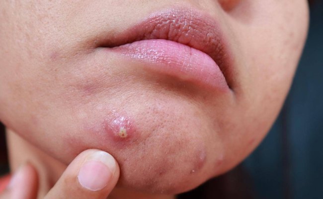 Da mặt đột nhiên nổi nhiều mụn do thay đổi nội tiết tố