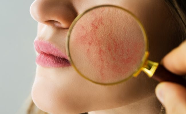 Cách Chăm Sóc Da Nhạy Cảm Vào Mùa Hè Hiệu Quả, Đúng Cách