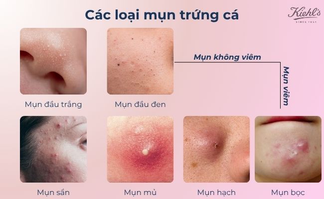 Các loại mụn trứng cá phổ biến
