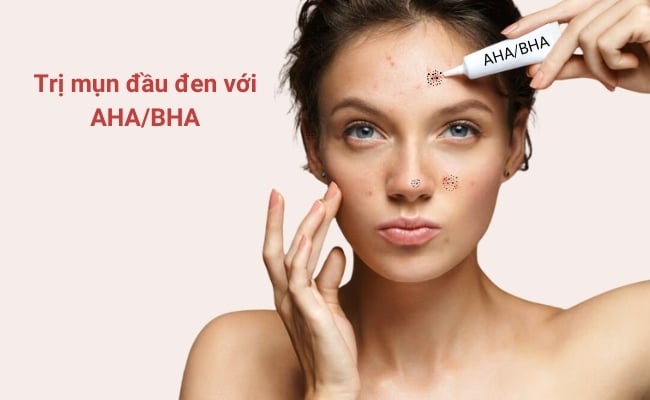 Cách trị mụn đầu đen tại nhà với AHA và BHA