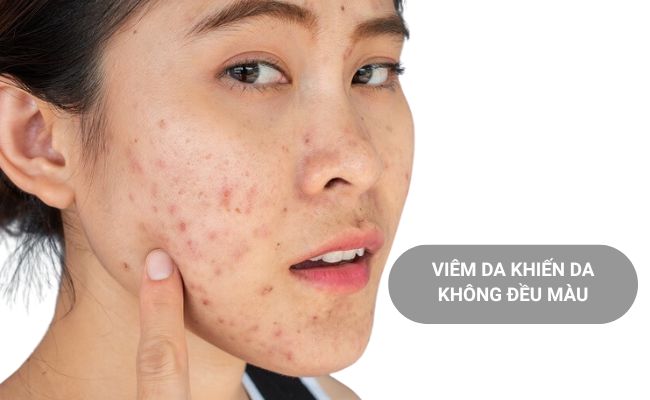 Viêm da khiến da không đều màu