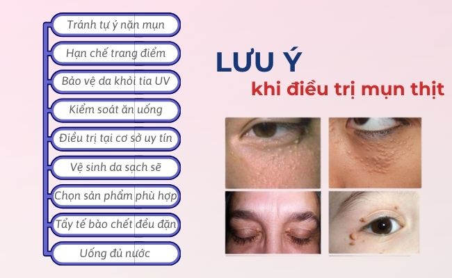 Lưu ý khi điều trị mụn thịt trên da