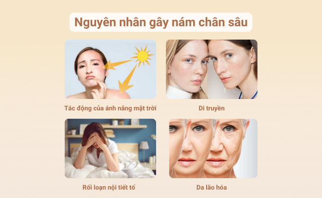 Tìm hiểu các yếu tố gây nám da như lão hóa, di truyền, rối loạn nội tiết tố...