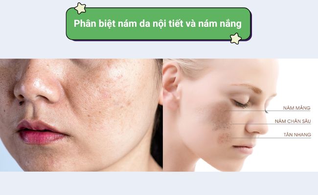 Cách phân biệt nám da nội tiết và nám nắng