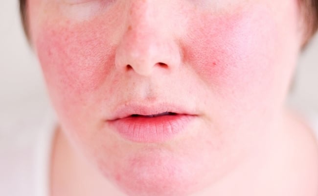 tác dụng phụ của tretinoin