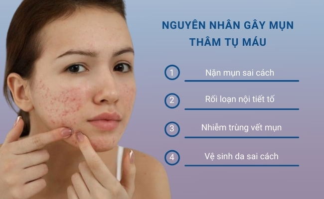 Mụn thâm tụ máu là kết quả của sự viêm nhiễm mụn trứng cá