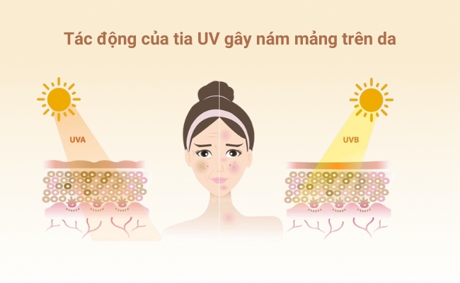 Tác động tiêu cực của tia UV gây nám mảng trên da