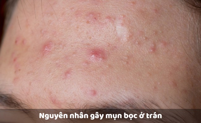 Nguyên nhân gây mụn bọc ở trán
