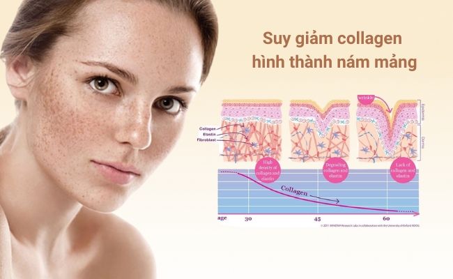 Nám mảng do suy giảm collagen