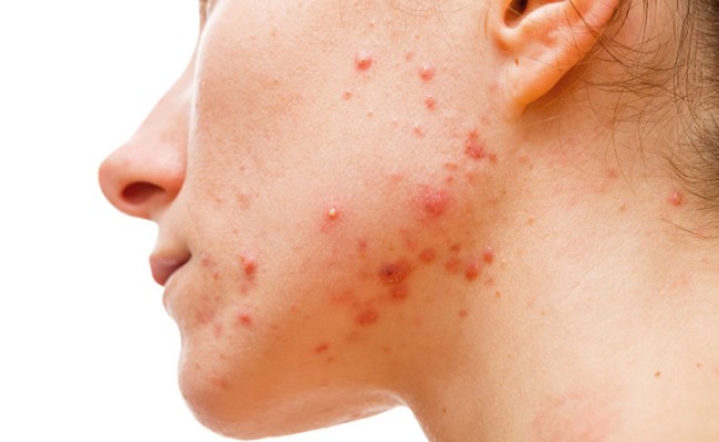 Các vị trí mụn nguy hiểm
