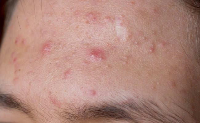 BHA đẩy mụn là gì? Tại sao dùng BHA bị đẩy mụn?