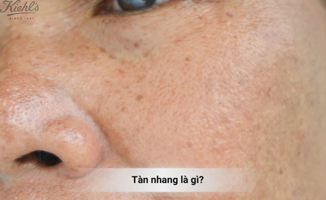 Tàn nhang là gì? Nguyên nhân gây ra tàn nhang