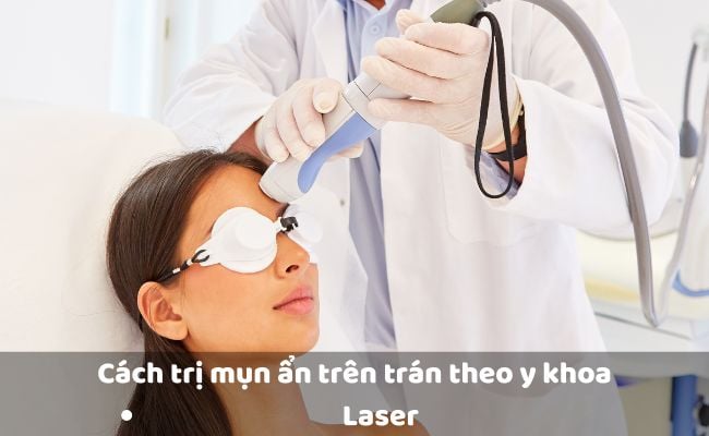 Cách trị mụn ẩn trên trán bằng laser