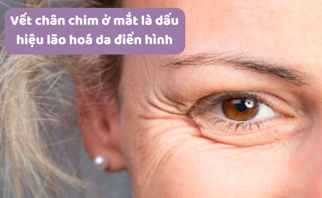 Vết chân chim là gì?