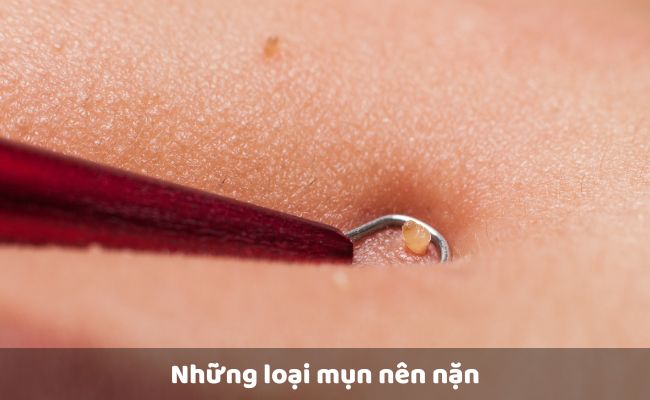 Những loại mụn nên nặn

