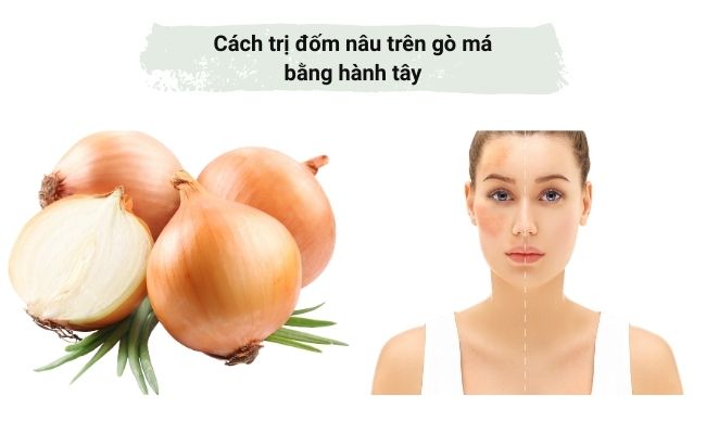 Cách trị đốm nâu trên gò má bằng hành tây