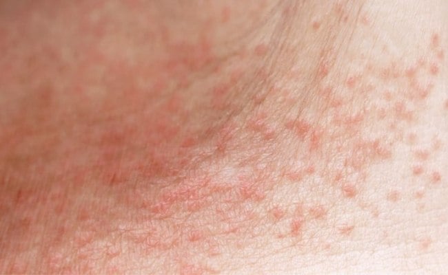 Rôm sảy - Nổi nốt đỏ trên da ở trẻ em

