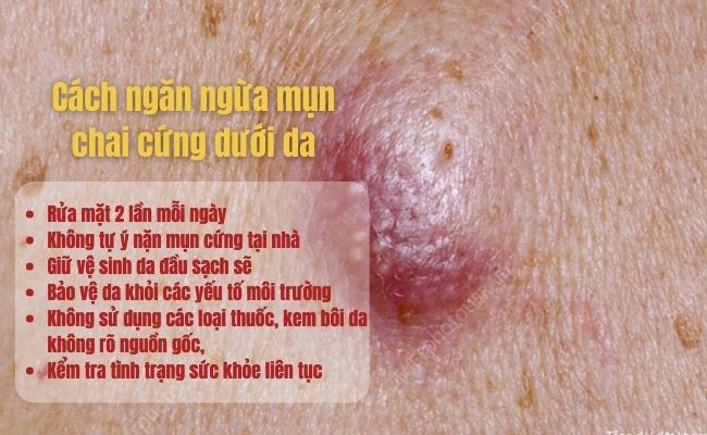 Cách ngăn ngừa mụn chai cứng dưới da