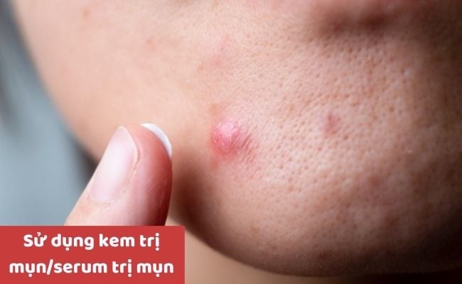 Cách điều trị mụn bọc ở cằm tại nhà?

